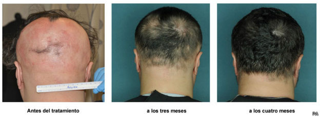 Alopecia