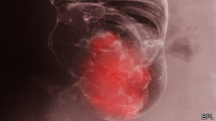 Rayos X mostrando cáncer del colon