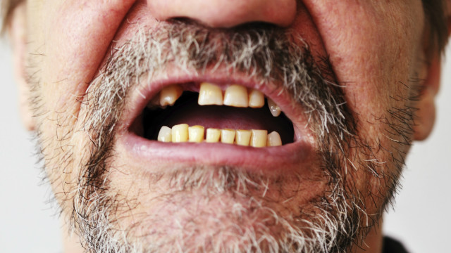 Как спасти гнилые зубы?