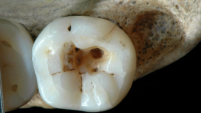 Как лечили зубы древние | Вокруг Света